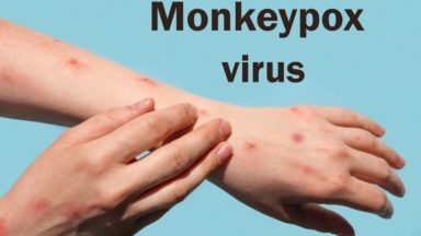 236 cas de variole du singe ont été recensés à Bruxelles